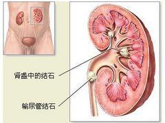 体外碎石治疗的首要选择_曙光：湖里尿道管结石