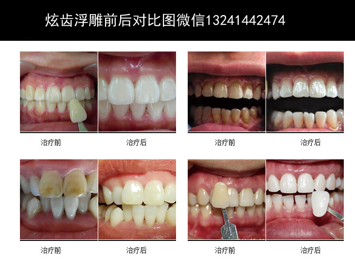 什么是冰瓷牙技术？为什么那么冰瓷牙火爆？