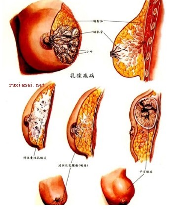 公益乳腺增生培训_邯郸公益乳腺增生培训机构