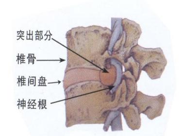 公益腰椎间盘突出培训 公益腰椎间盘突出培训机构