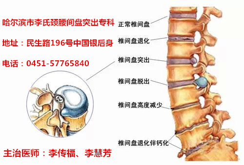 哈爾濱市李氏頸腰間盤突出?？?451-57765840