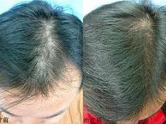 西安粉刺zl_陜西{yl}的西安粉刺zl