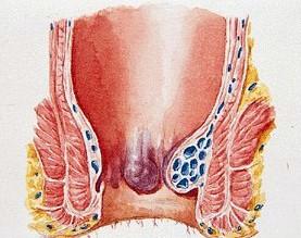 蹲側(cè)看報(bào)痔瘡報(bào)道痔愈丸痔舒茶痔瘡套餐輕松治痔瘡不反復(fù)