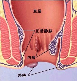 產后痔瘡怎么辦？痔舒茶對產后痔瘡zl效果好，認準尚草牌子