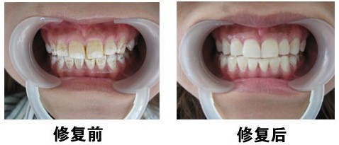 北京通州區(qū)牙齒發(fā)黃洗牙的價格_北京市哪家牙齒美容效果好