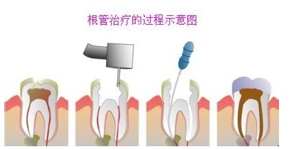 北京市根管zl費用——根管zl當(dāng)選齒康口腔