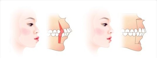 北京市可靠的牙齒美白推薦_北京通州冷光美白多少錢