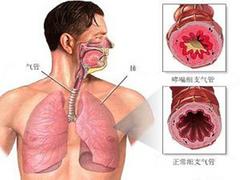 肺氣腫能治好嗎_陜西專業(yè)肺氣腫zl機(jī)構(gòu)是哪家