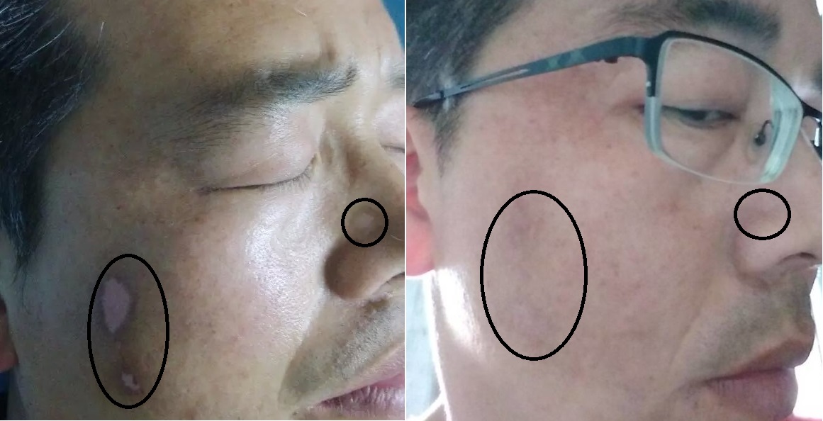 白白手拉手論壇——哪家醫院治療白癜風效果好