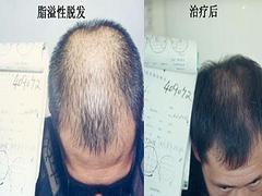 脫發(fā)治療哪里好，西安脫發(fā)治療專(zhuān)科找哪家