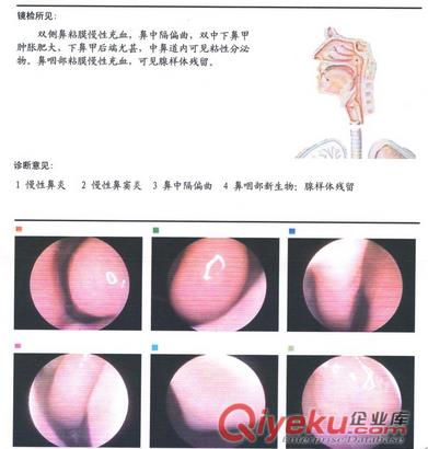 秦皇島治鼻炎