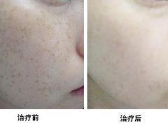 阜陽提眉哪家專業(yè)|阜陽眉毛整形價格