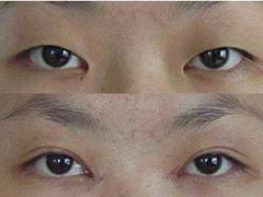 阜陽隆鼻手術價格_安徽{yl}的隆鼻推薦
