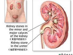 安全的腎結石zl推薦：同安腎結石