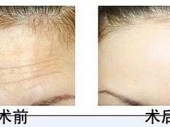華康醫(yī)療美容——具有口碑的除皺服務(wù)團(tuán)隊(duì)|除皺價(jià)格