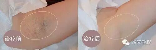 哪里有提供高水平的OPT快速脫毛——廊坊脫毛價格范圍
