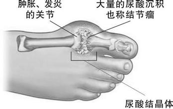 福建{yl}的痛風(fēng)zl——痛風(fēng)急性發(fā)作怎么辦