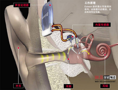 助听器/采购/优惠/种类/德州运河经济开发区春晓助听器