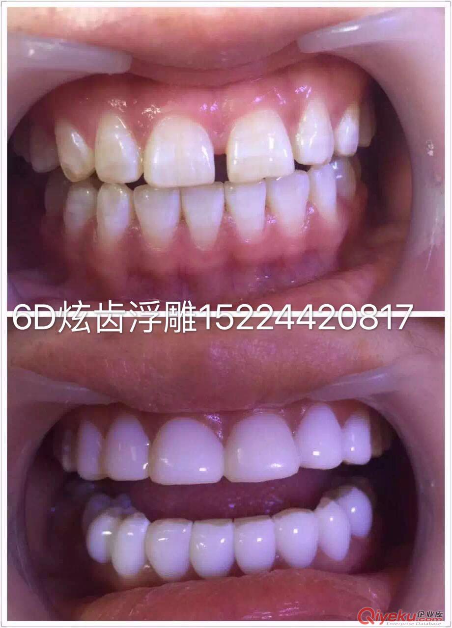 6D炫齒浮雕