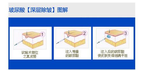 北京具有口碑的北京基礎(chǔ)美玻尿酸注射費(fèi)用價(jià)格|玻尿酸注射產(chǎn)品費(fèi)用